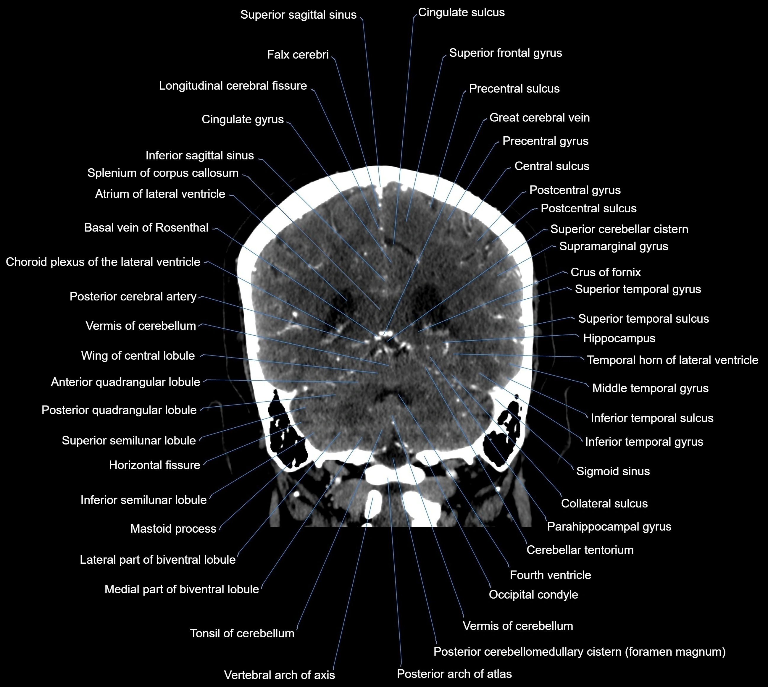CT Brain coronal cross sectional radiology anatomy image  -img-00001-032.webp